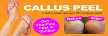 The wonder treatment of Callus Peel